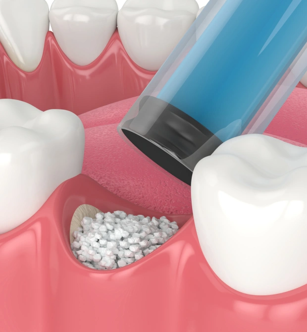 Bone Grafting