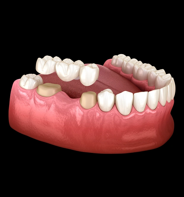 Dental Bridges