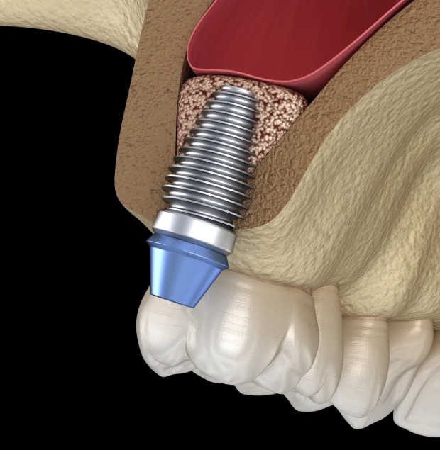 Sinus Lift