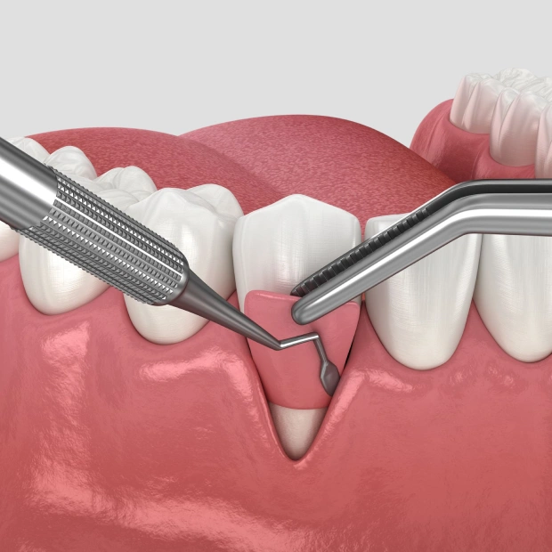 Tissue Grafting